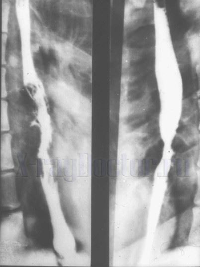 Рентгенограммы при прямом контрастировании пищевода